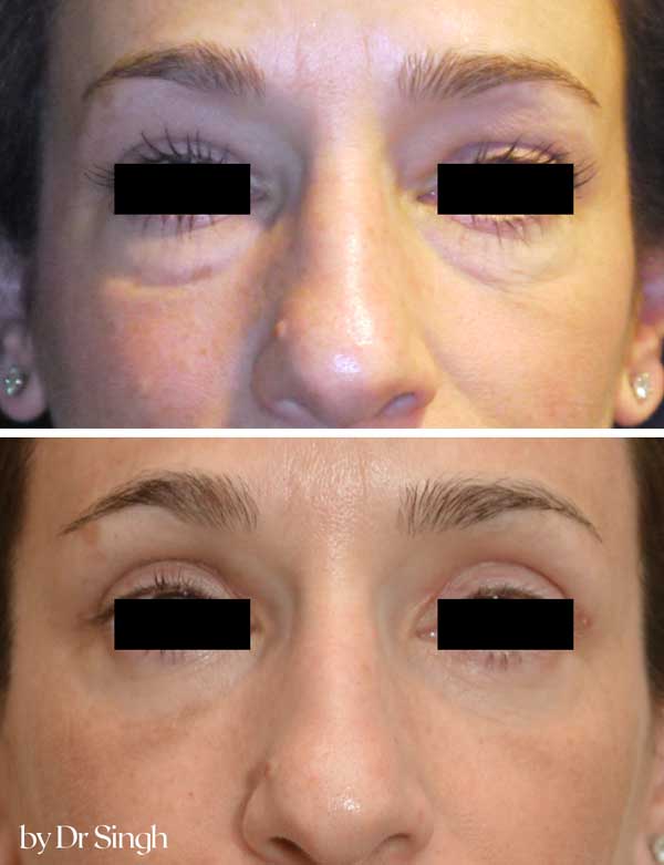 before after blepharoplasty nyc